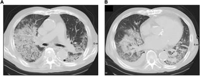 Development of Alveolar Hemorrhage After Pfizer-BioNTech COVID-19 mRNA Vaccination in a Patient With Renal-Limited Anti-neutrophil Cytoplasmic Antibody-Associated Vasculitis: A Case Report